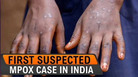 Mpox detected for first time in India